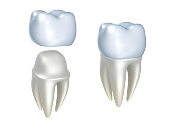 Crown Treatment Calgary | Copperstone Dental | Calgary General Dentistry
