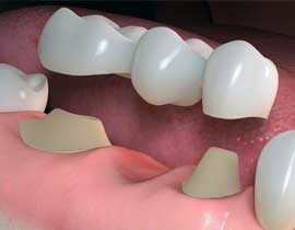 Dental Bridges