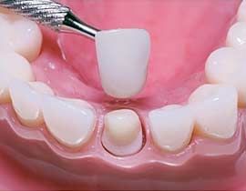 Calgary Dental Crowns | Copperstone Dental