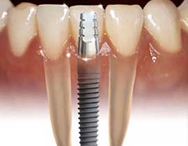 Dental Implants