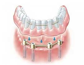 SE Calgary Implant Supported Dentures
