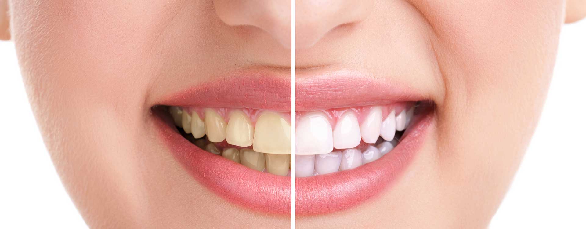 FREE Teeth Whitening For Life | Copperstone Dental | Calgary General Dentistry
