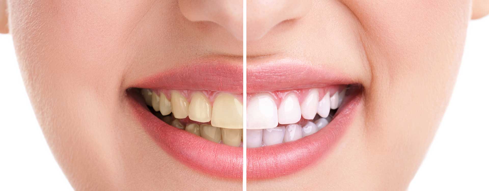 Copperstone Dental | FREE Teeth Whitening For Life