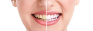 Copperstone Dental | FREE Teeth Whitening For Life